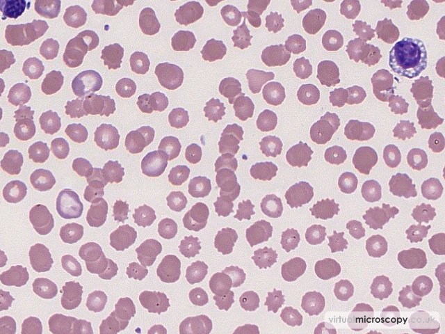 Rouleaux - Splenic Marginal Zone Lymphoma