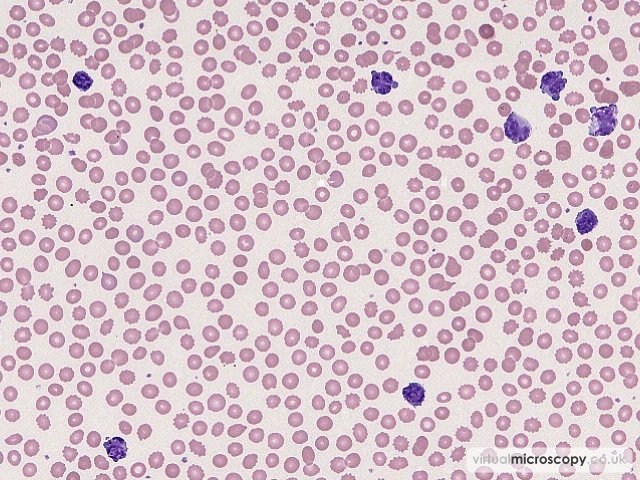 Unexciting Red Cell Morphology - Splenic Marginal Zone Lymphoma