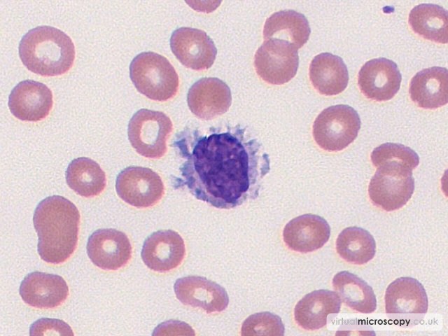 Hairy Cell - Hairy Cell Leukaemia