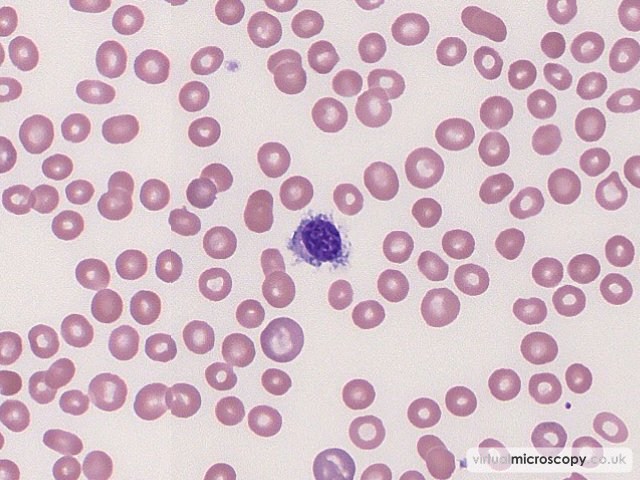 Hairy Cell - Hairy Cell Leukaemia