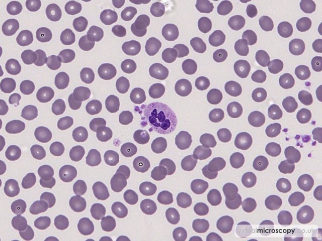 Platelet Satellitism - Platelet Clumping