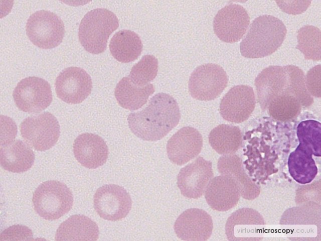 Pappenheimer Bodies - Acute Myeloid Leukaemia with Eosinophilia (Inversion 16)