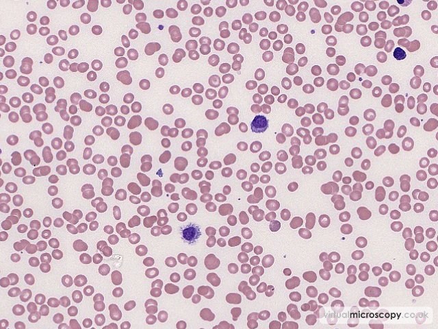 Hairy Cells - Hairy Cell Leukaemia
