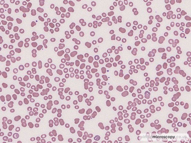 Mild Rouleaux - Hairy Cell Leukaemia