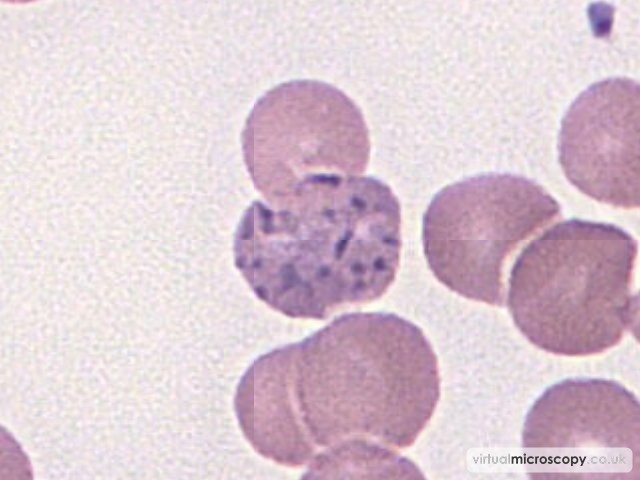 Prominent Basophilic Stippling - Lead Poisoning