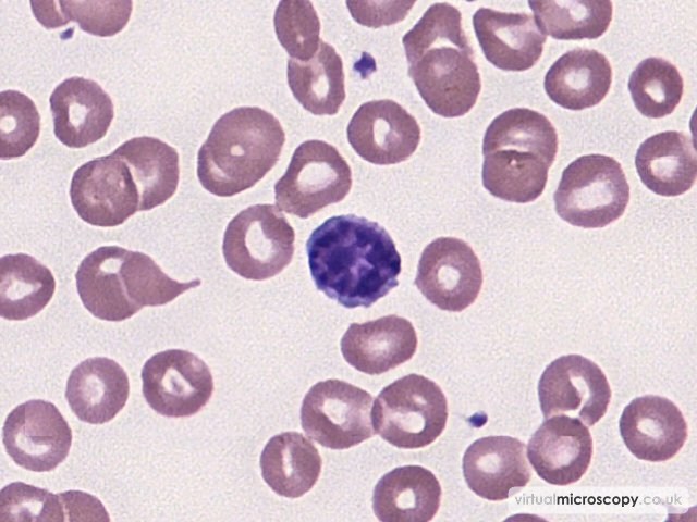 Microcytosis - Lead Poisoning