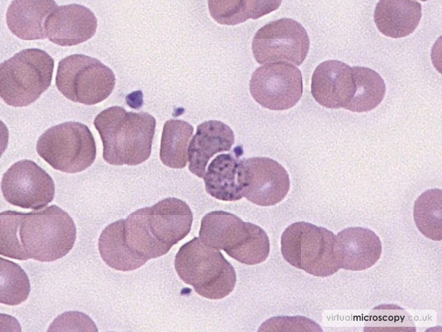 Basophillic Stippling - Lead Poisoning