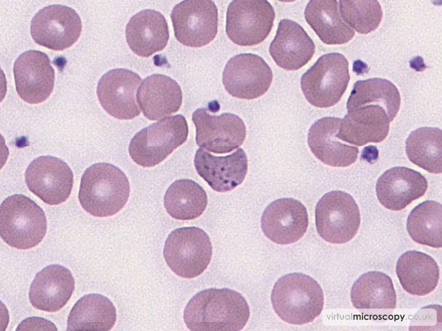 Basophillic Stippling - Lead Poisoning