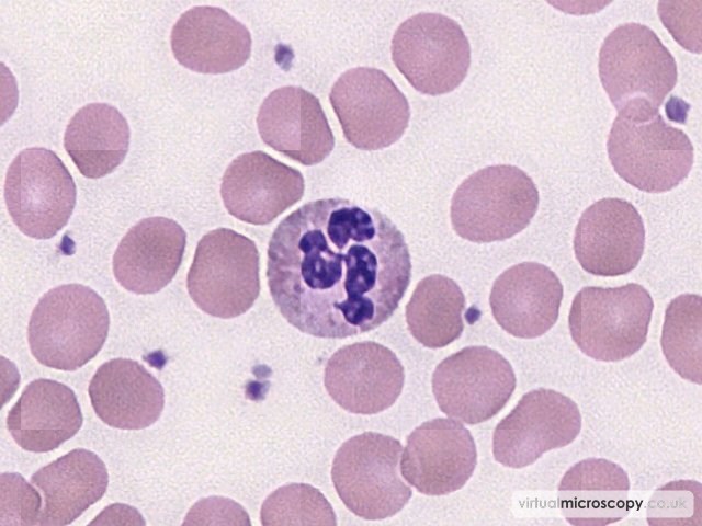 Normal Neutrophil - Lead Poisoning