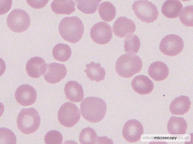 Acanthocyte - Acute Myeloid Leukaemia with Eosinophilia (Inversion 16)