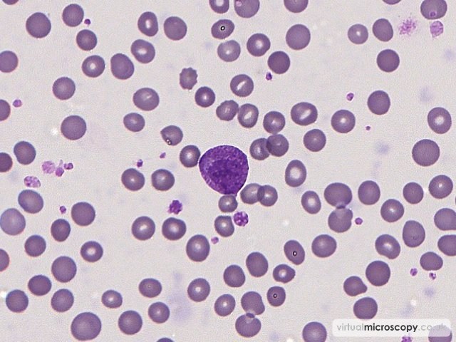 Myelocyte (Left shift) - Sepsis - Bactaraemia in a patient on intensive care