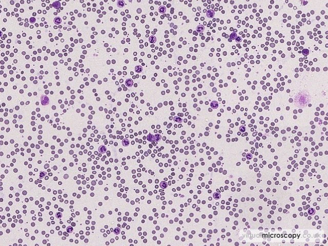 Neutrophilia - Sepsis - Bactaraemia in a patient on intensive care