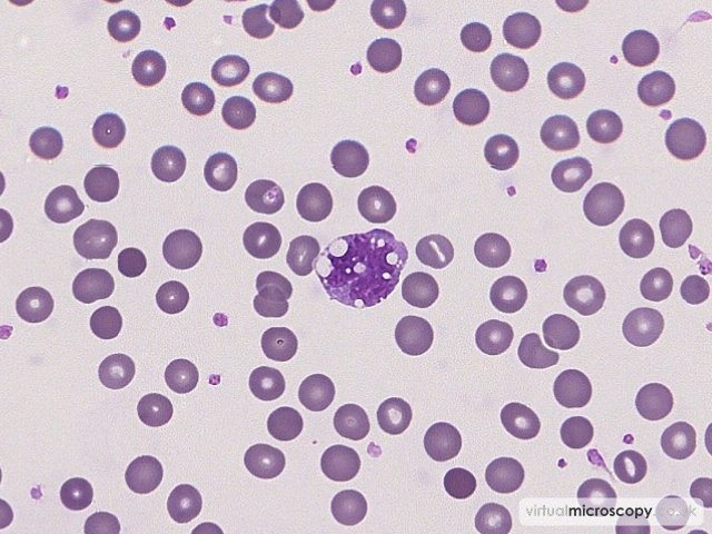 Reactive Monocyte - Sepsis - Bactaraemia in a patient on intensive care