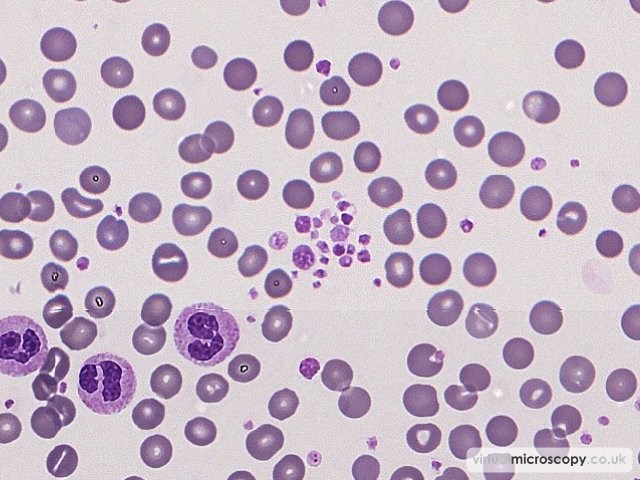 Platelet Clump - Sepsis - Bactaraemia in a patient on intensive care