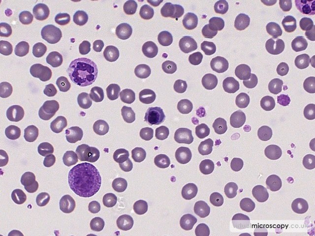 Nucleated Red Blood Cell - Sepsis - Bactaraemia in a patient on intensive care