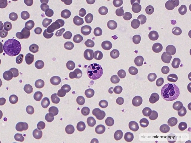 Apoptotic Neutrophil - Sepsis - Bactaraemia in a patient on intensive care