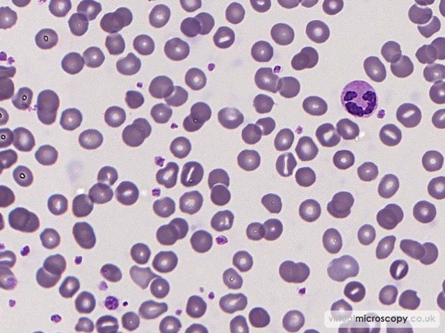 Stomatocytes - Sepsis - Bactaraemia in a patient on intensive care