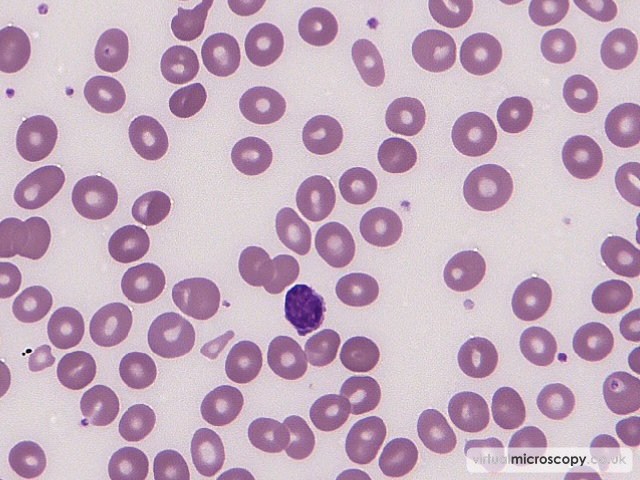 Macrocytic Red Cells - B12 Deficiency