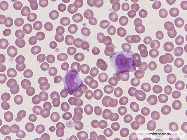 Reactive Lymphocytes - Glandular Fever