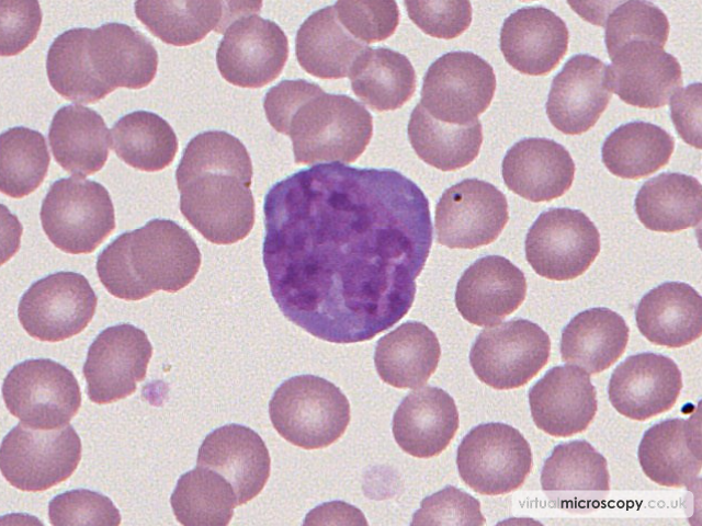 Lymphoplasmacytoid Lymphocyte - Glandular Fever