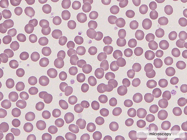 Rouleaux - Glandular Fever