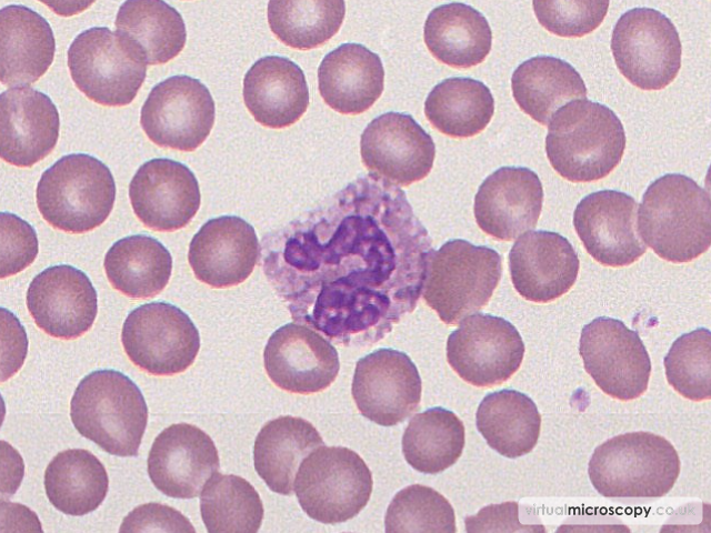 Toxic Granulation - Glandular Fever