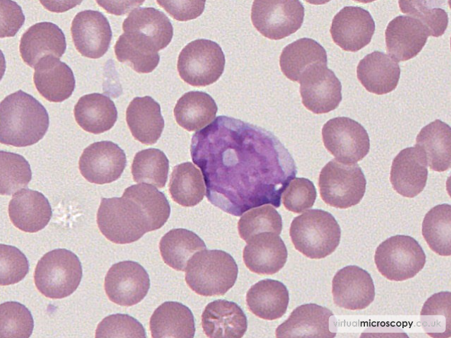 Atypical Lymphocyte - Glandular Fever