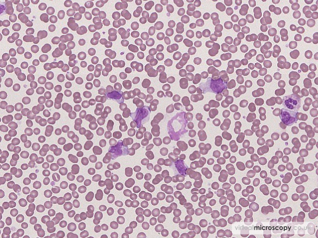 Reactive LYmphocytes - Glandular Fever