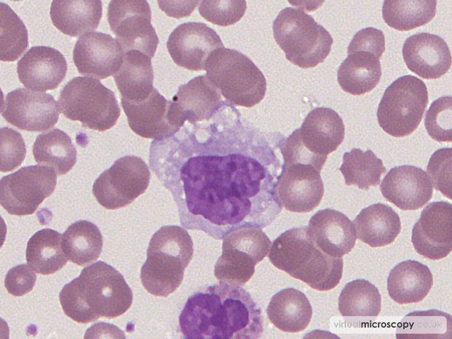 Reactive Monocyte - Glandular Fever