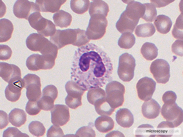 Toxic Granulation - Glandular Fever