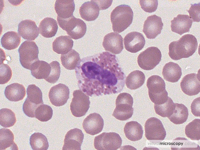 Normal Eosinophil - Glandular Fever