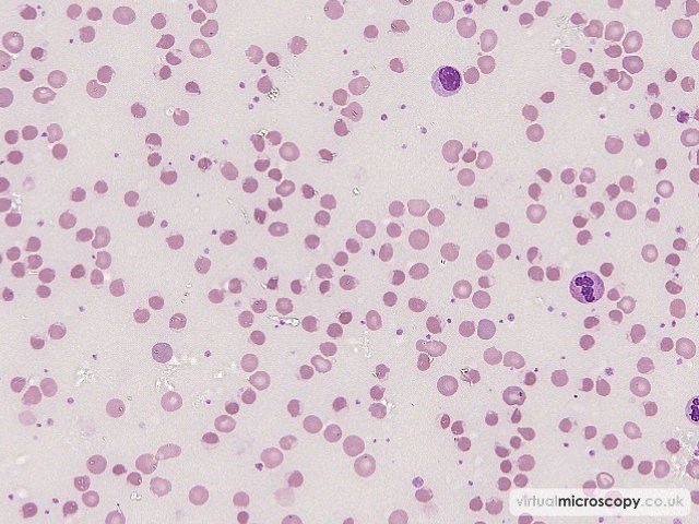 Anaemia - G6PD deficiency in crisis