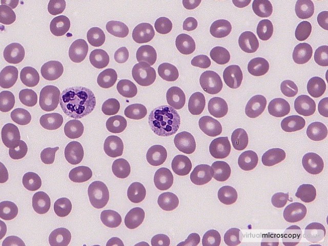 Hypersegmented Neutrophil - B12 Deficiency
