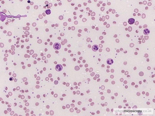 Reactive Neutrophilia - G6PD deficiency in crisis