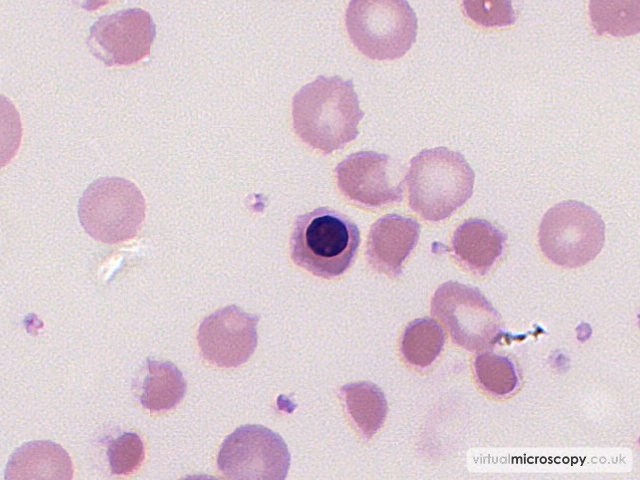 Nucleated Red Cell - G6PD deficiency in crisis