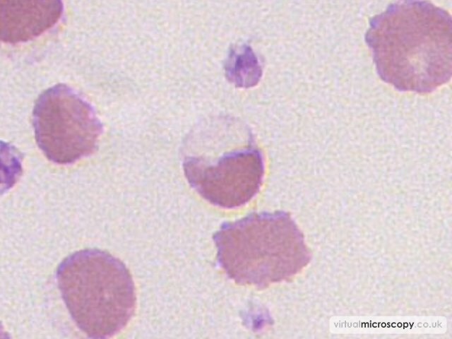 Blister Cell or Hemighost - G6PD deficiency in crisis