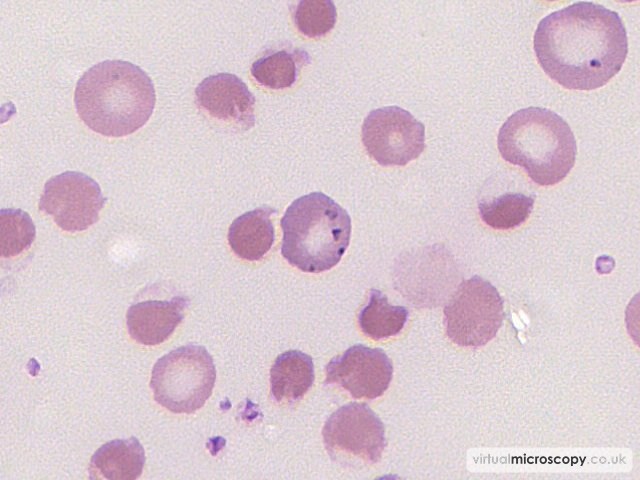 Pappenheimer bodies - G6PD deficiency in crisis
