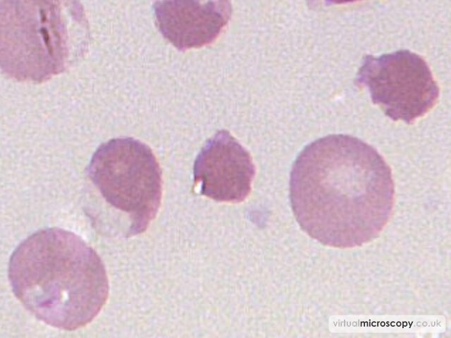 Irregularly Contracted Cell - G6PD deficiency in crisis