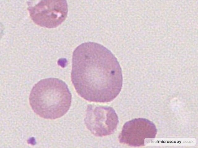 Reticuloyte - G6PD deficiency in crisis