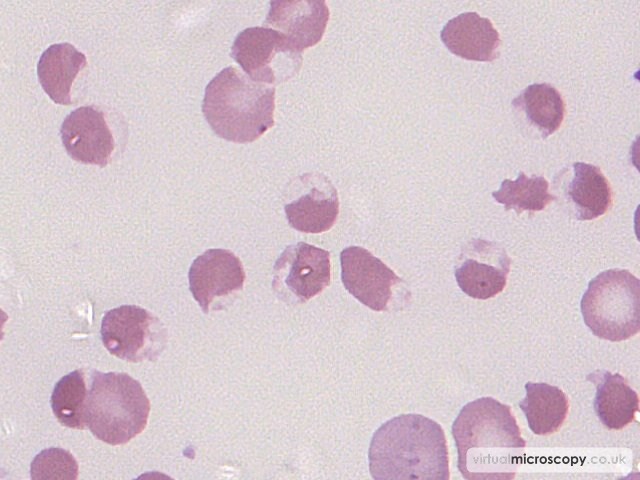 Blister Cells - G6PD deficiency in crisis