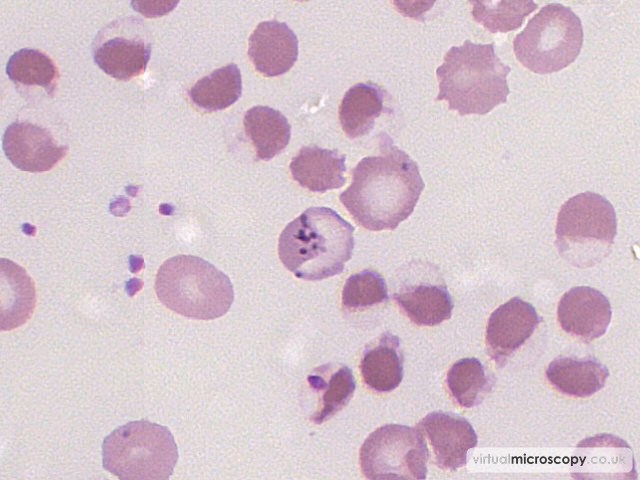 Pappenheimer Bodies - G6PD deficiency in crisis