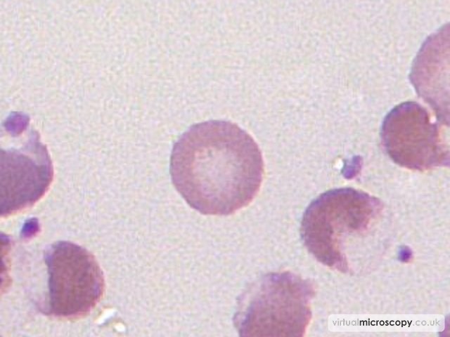 Normal Red Cell - G6PD deficiency in crisis