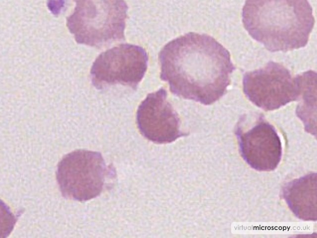 Bite Cell or Keratocyte - G6PD deficiency in crisis