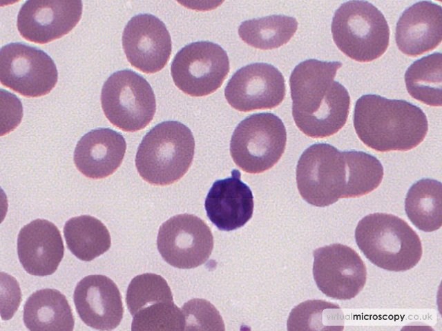 Macrocytic Red Cells II - B12 Deficiency
