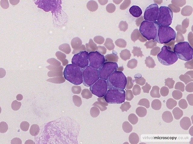 Clump of Blasts - Acute Myeloid Leukaemia