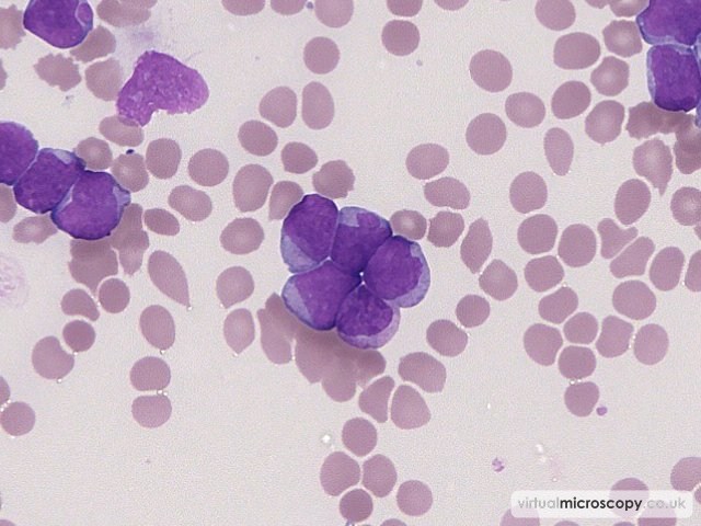 Pleomorphic Nuclei in Blasts - Acute Myeloid Leukaemia