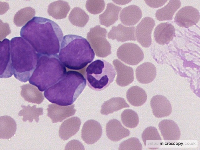 Hypogranular Neutrophil - Acute Myeloid Leukaemia