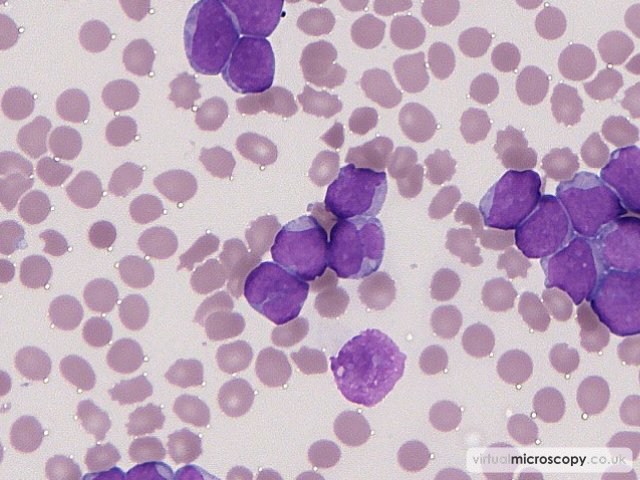 Pleomorphic Nuclei - Acute Myeloid Leukaemia