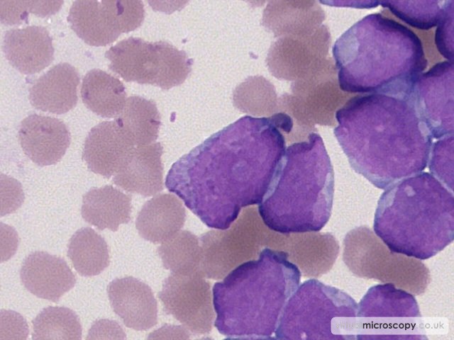 Granular Blast - Acute Myeloid Leukaemia