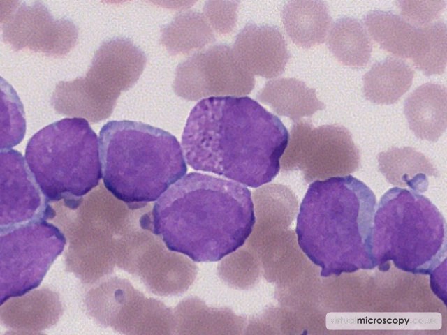 Granular Blasts - Acute Myeloid Leukaemia